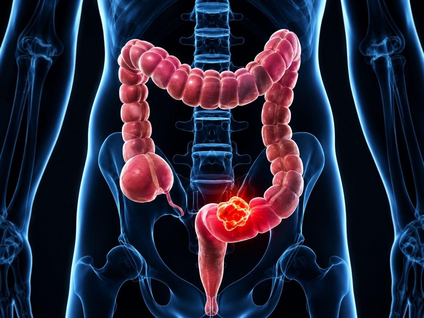 Cáncer Colorrectal